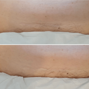 before and after scar