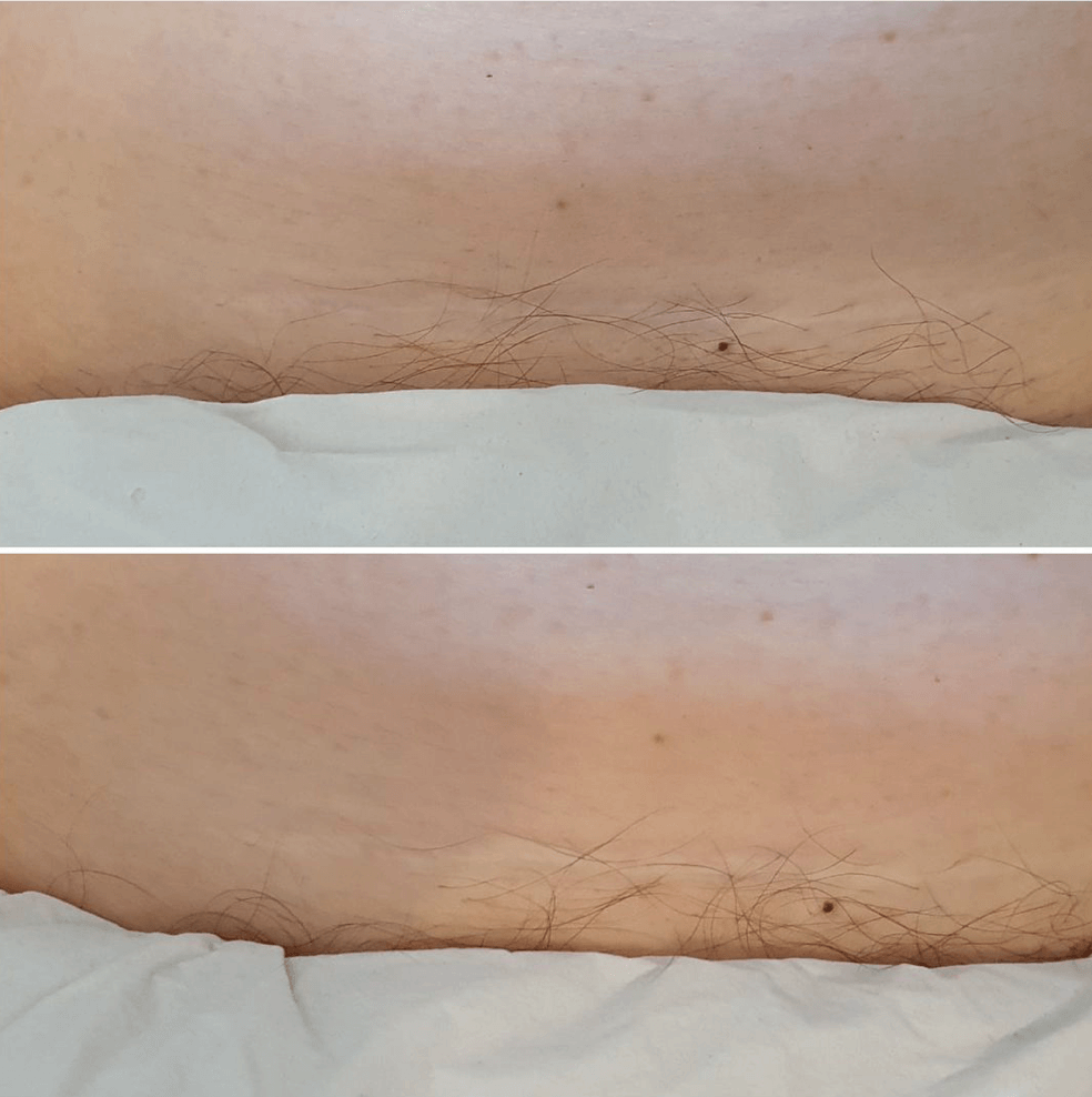 before and after scar